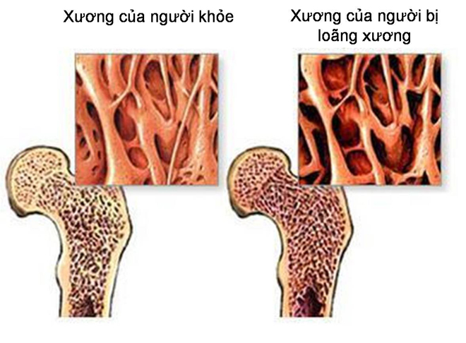 Thiếu canxi - nguyên nhân hàng đầu gây bệnh loãng xương
