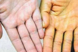 Sức khỏe đời sống - Những dấu hiệu cảnh báo lá gan đang "kêu cứu"