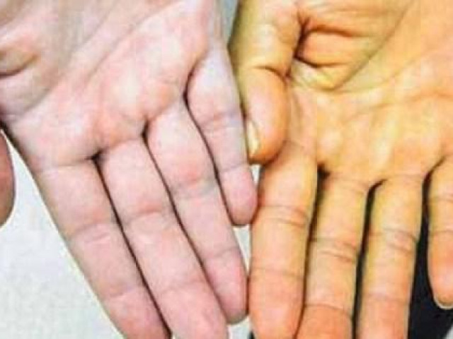 Sức khỏe đời sống - Những dấu hiệu cảnh báo lá gan đang "kêu cứu"