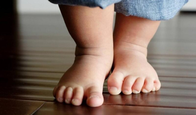 Bàn chân bẹt là một trong những tật về phát triển vận động thường gặp ở trẻ.