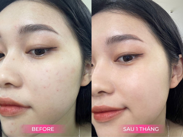 Khách hàng sử dụng sản phẩm Niacinamide 10% Ampoule Vacure:treat