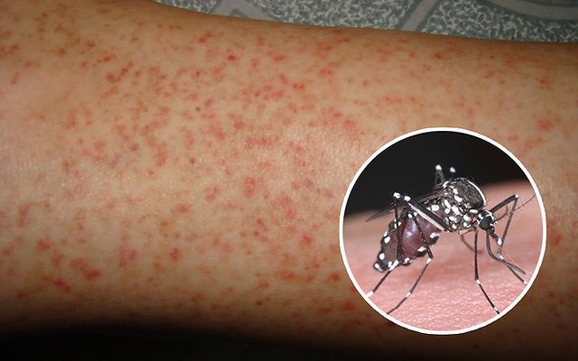 Bệnh sốt xuất huyết Dengue có phòng ngừa được không?
