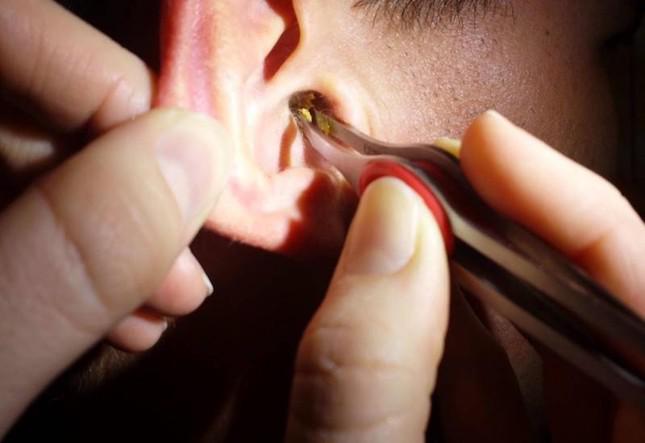 Những cách lấy ráy tai sai lầm có thể khiến bạn điếc vĩnh viễn - 1