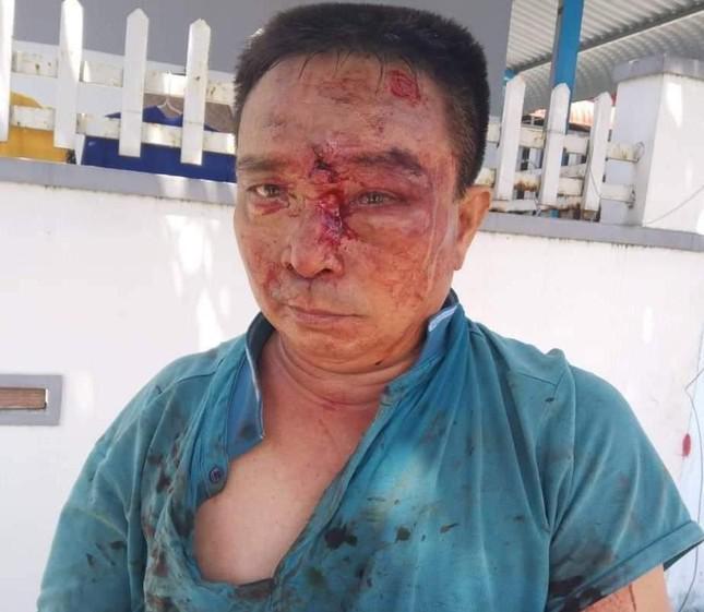 Ông Nguyễn Quang Hào bị người của xe khách đánh trọng thương ở vùng đầu. Ảnh L.H
