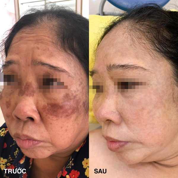 Điều trị đốm nâu nội tiết tại Ngọc Hường