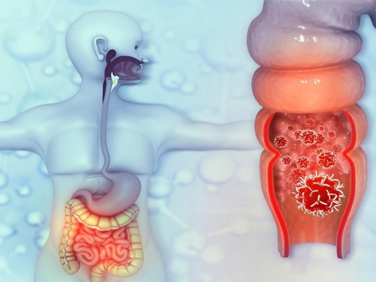 Sức khỏe đời sống - Muốn tránh "sát thủ" ung thư đại trực tràng, bạn cần biết những điều này