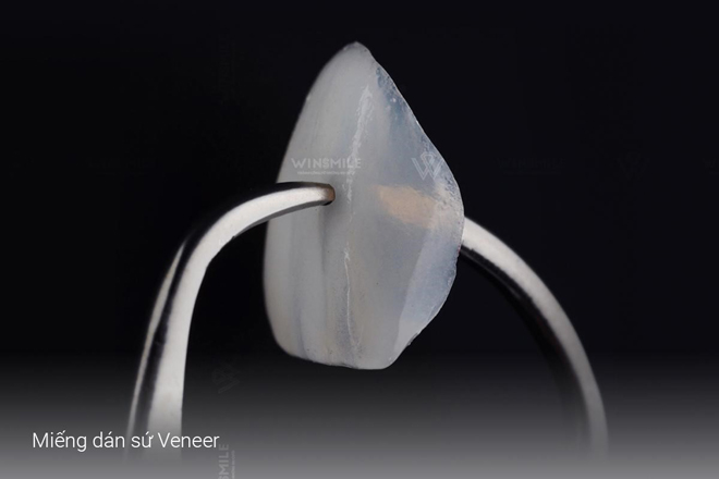 Dán sứ Veneer - Phương pháp thẩm mỹ răng hàng đầu hiện nay