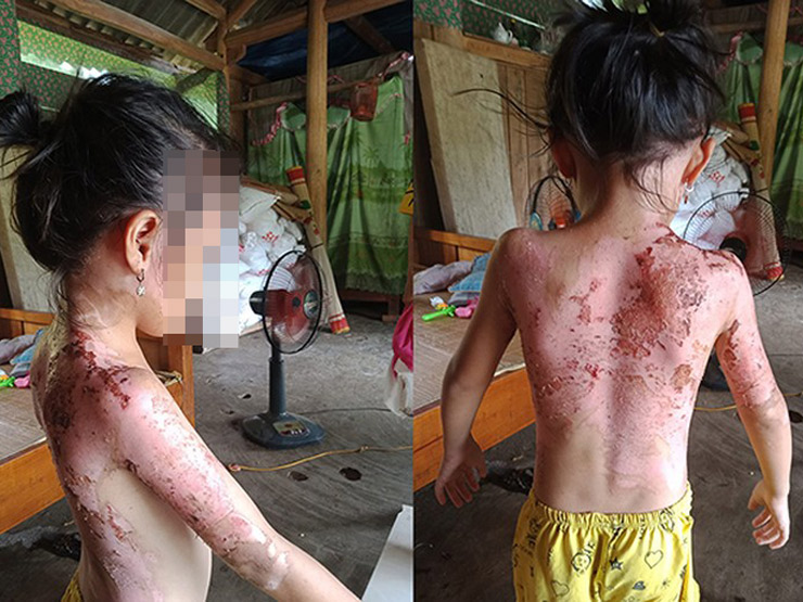 Pháp luật - Bé gái bị hàng xóm dội nước sôi vào người