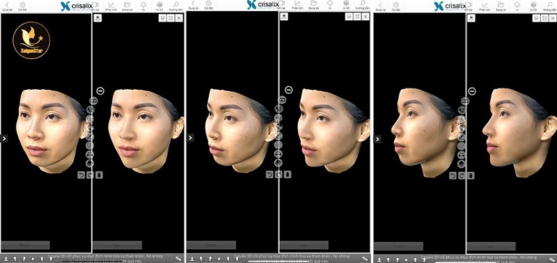 Ứng dụng công nghệ Crisalix 3D - Nhìn trước tương lai kết quả thẩm mỹ cùng Bác sĩ Nguyễn Hữu Hoạt - 2