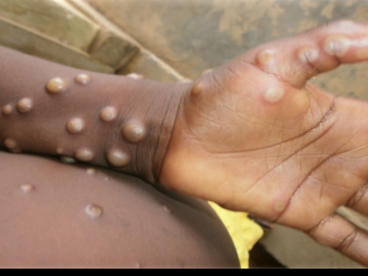 Sức khỏe đời sống - Gần 16.000 ca mắc đậu mùa khỉ trên thế giới, người mắc bệnh có dấu hiệu gì?