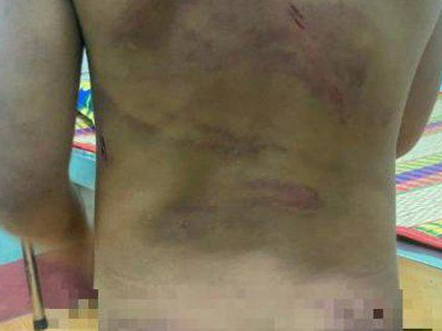 Pháp luật - Bình Phước: Bé gái nghi bị bạo hành với nhiều vết thương chi chít trên cơ thể