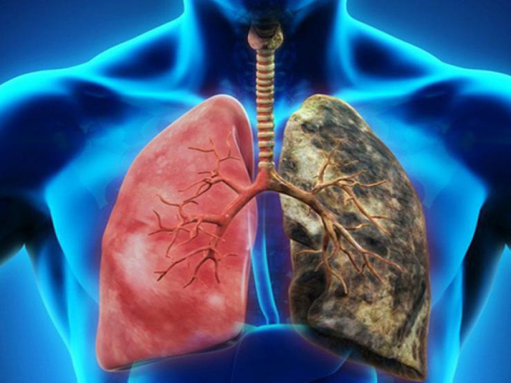 Sức khỏe đời sống - Người đàn ông phát hiện ung thư phổi sau đau ngực, ho khan