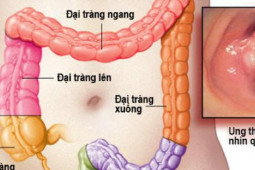 Sức khỏe đời sống - 6 dấu hiệu sớm cảnh báo ung thư trực tràng, đáng tiếc là nhiều người ngại khám và bỏ qua!
