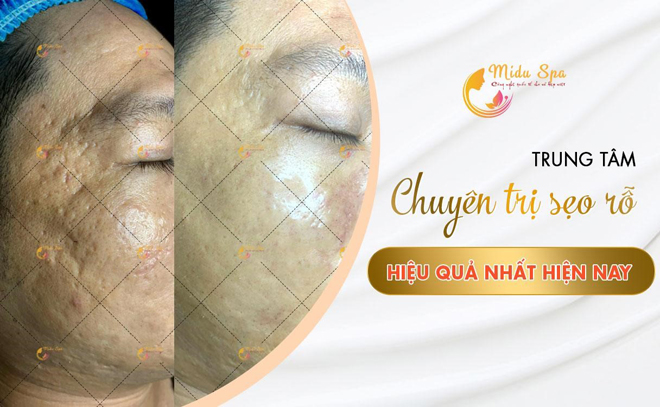 Phương pháp trị sẹo rỗ đột phá tại Midu Spa