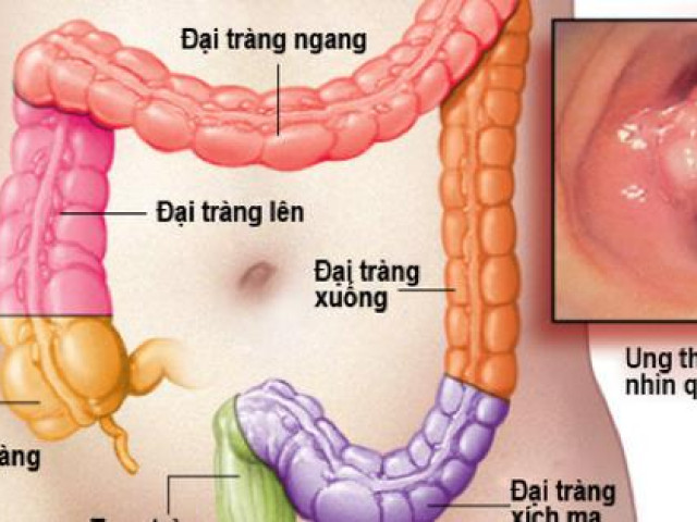 6 dấu hiệu sớm cảnh báo ung thư trực tràng, đáng tiếc là nhiều người ngại khám và bỏ qua!