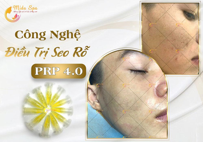 Công nghệ điều trị sẹo rỗ hiện đạiPRP 4.0