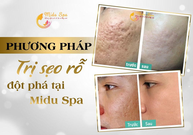 Midu Spa - Trung tâm chuyên trị sẹo rỗ hiệu quả nhất hiện nay