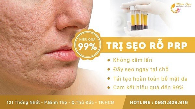 Điều trị sẹo rỗ tại Midu hiệu quả đến 99%