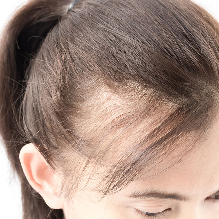3 cách giúp giảm tóc rụng, hói đầu, lấy lại làn tóc mây bồng bềnh - 1