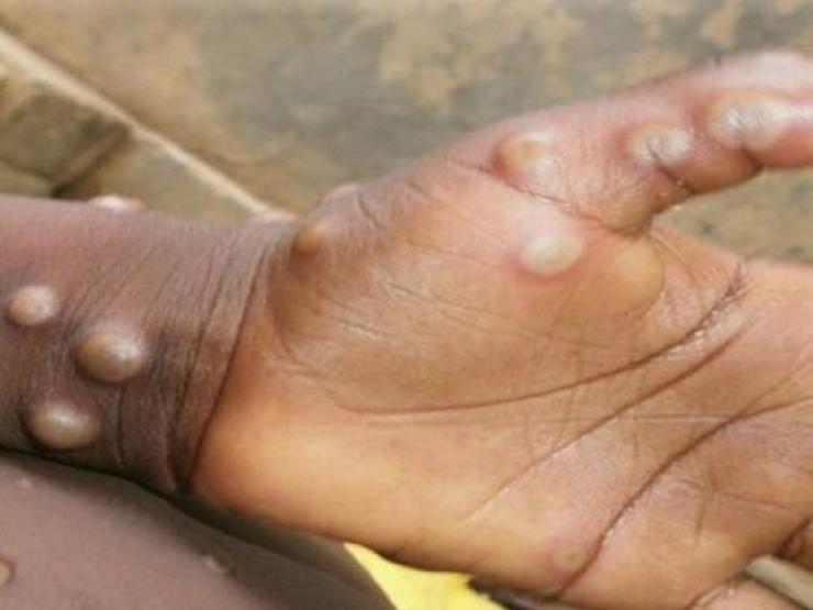 Sức khỏe đời sống - Quyền Bộ trưởng Y tế: "Nguy cơ dịch chồng dịch là hiện hữu"