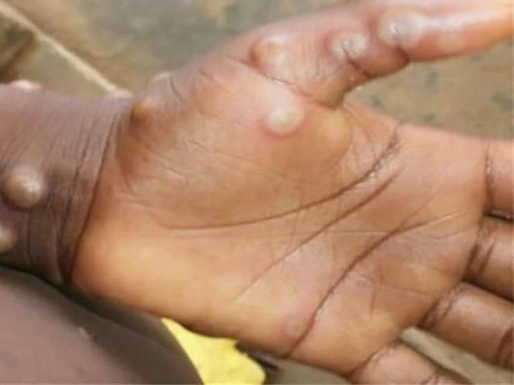 Người mắc bệnh đậu mùa khỉ cách ly tối thiểu 14 ngày