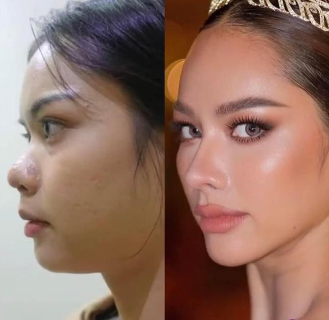 Tân Hoa hậu Hoàn vũ Thái Lan 2022 lộ ảnh trước khi phẫu thuật thẩm mỹ - 4