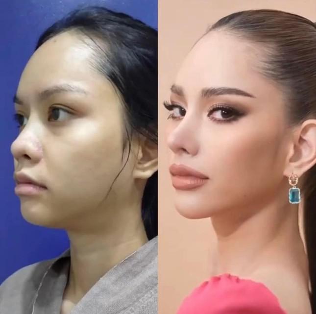 Tân Hoa hậu Hoàn vũ Thái Lan 2022 lộ ảnh trước khi phẫu thuật thẩm mỹ - 3
