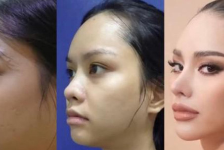 Tân Hoa hậu Hoàn vũ Thái Lan 2022 lộ ảnh trước khi phẫu thuật thẩm mỹ
