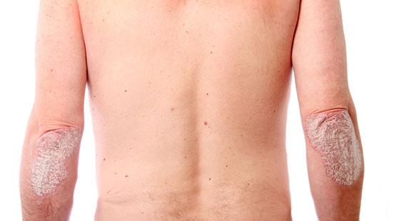 Căn bệnh khiến “nàng tiên cá” Dara Torres khổ sở, những ai có nguy cơ mắc? - 3