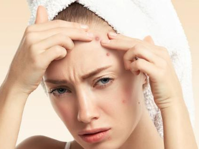 Làm đẹp - Nặn mụn đúng cách và an toàn tại nhà