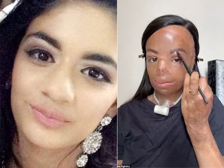 Bạn trẻ - Cuộc sống - Clip: Nghị lực phi thường của cô gái bị bỏng nặng ở tuổi 12