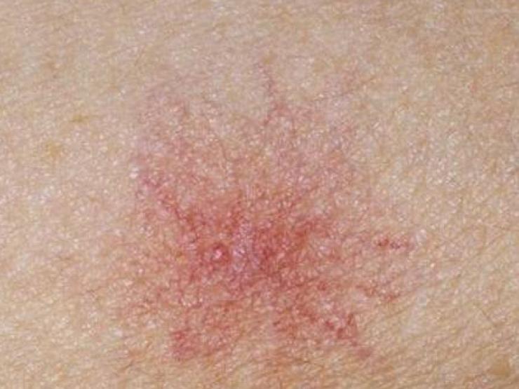 Sức khỏe đời sống - Xuất hiện những chấm đỏ này cần đi khám ngay lập tức, dấu hiệu bệnh gan đang ghé thăm