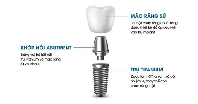 Cấu tạo của răng Implant