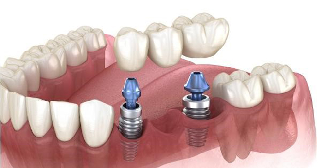 Kỹ thuật bắc cầu Implant cho các răng mất liền kề