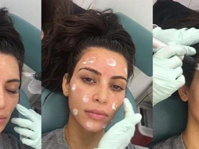 Làm đẹp - 4 phương pháp làm đẹp đau đớn của Kim Kardashian: "Mặt nạ ma cà rồng" gây khiếp sợ