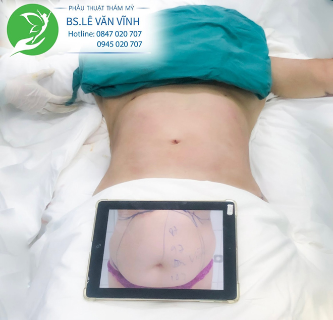 Hút mỡ bụng nữ tạo hình thành bụng phẳng phiu, nhẹ nhàng