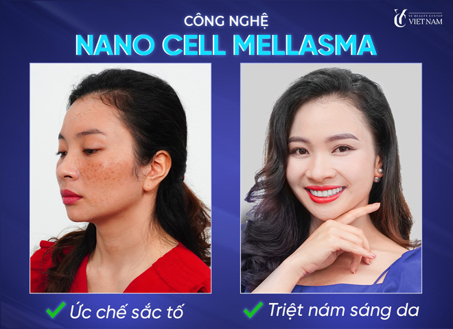 Chị Hải Hà trong quá trình điều trị nám bằng công nghệ Nano Cell Melasma tại Phòng khám Da liễu Quốc tế YC