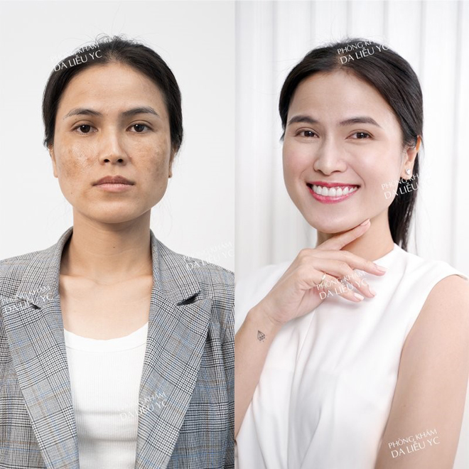 Công nghệ trị nám Nanocell Melasma tại Phòng khám Da liễu Quốc tế YC có ưu điểm vượt trội gì? - 5