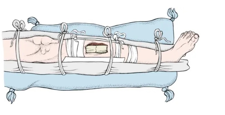 Lịch sử điều trị gãy xương, từ nẹp gỗ đến cố định bằng đinh vít - 4