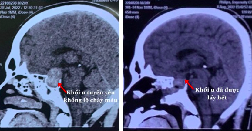 Hình ảnh chụp phim trước và sau mổ của bệnh nhân.