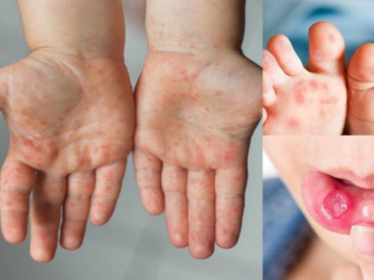 Bệnh tay chân miệng ở Hà Nội tăng hơn 5 lần, những sai lầm cha mẹ cần tránh