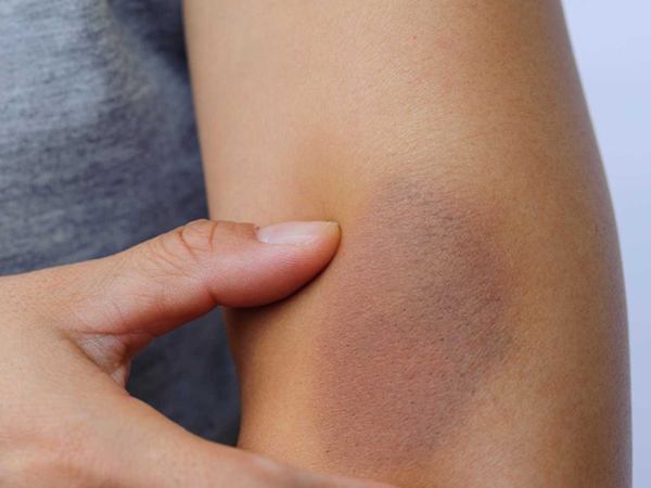 Bầm tím xuất hiện do nhiều nguyên nhân như va đập, ngã xe, tai nạn, thể thao...