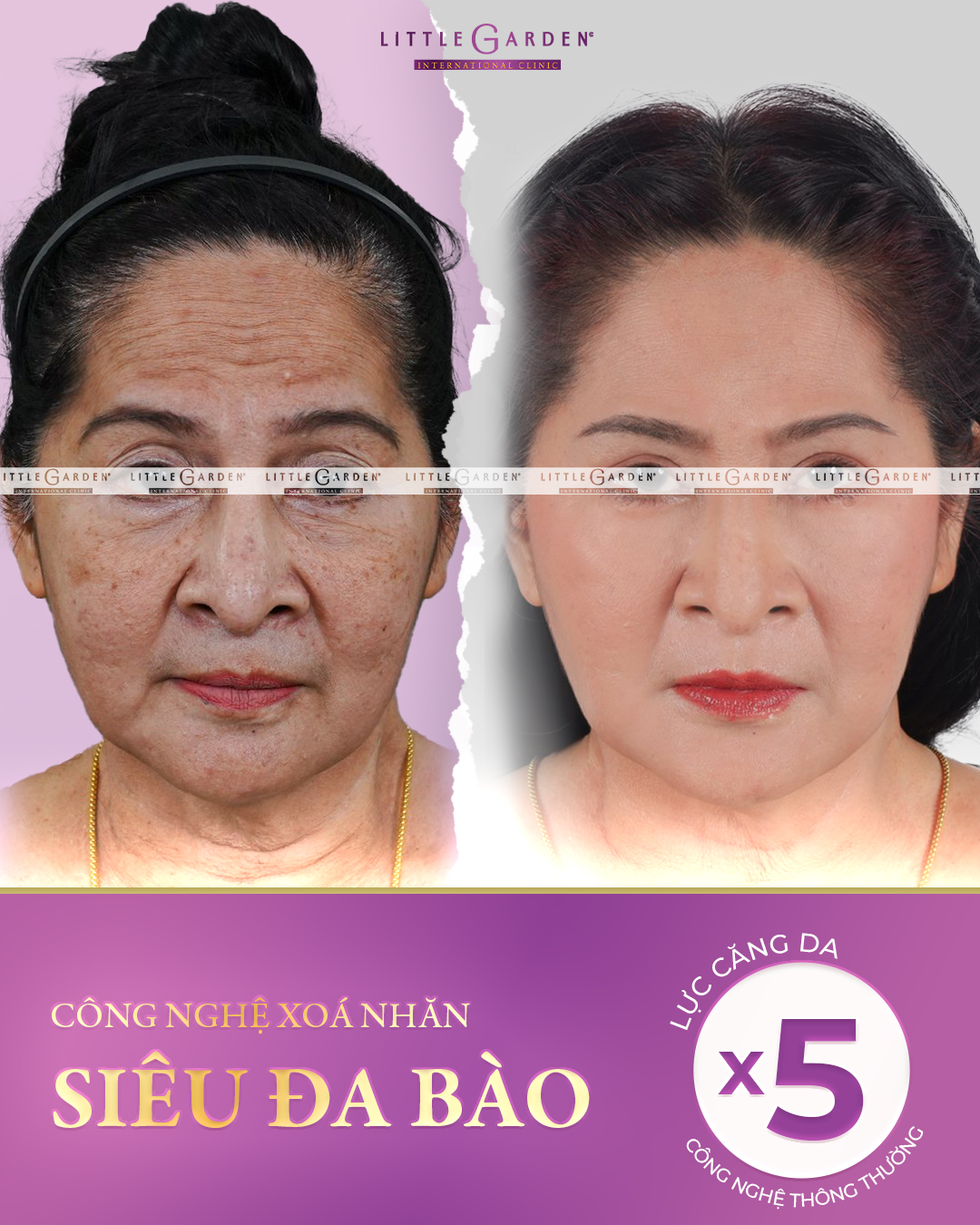 Tìm lại thanh xuân “ngay và luôn” bằng công nghệ xóa nhăn siêu đa bào - 3