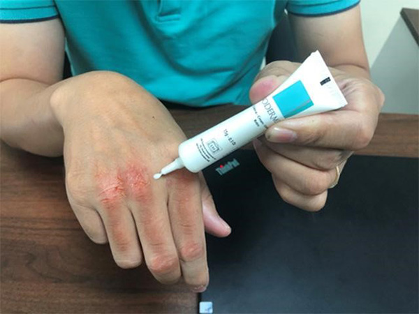 Tay anh Kiên đã đỡ được rất nhiều khi dùng Sodermix