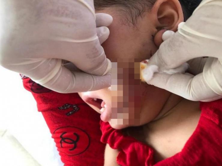 Tin tức trong ngày - Chó dại tấn công gây thương tích nặng cho bé 19 tháng tuổi