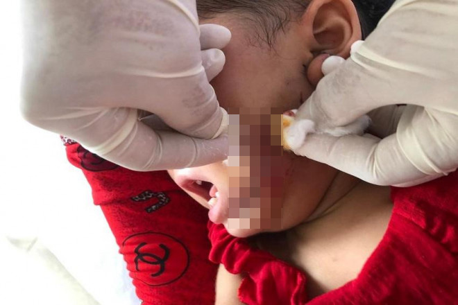 Vết thương trên mặt bé B.N.M sau 4 ngày điều trị tại Bệnh viện Sản- Nhi Cà Mau. Ảnh: CTV.