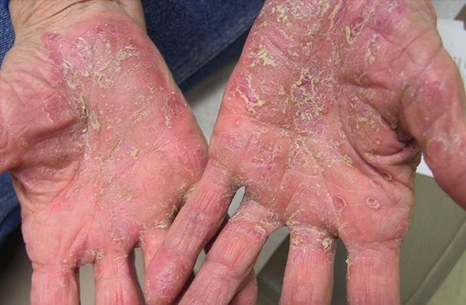 Lòng bàn tay luôn đỏ lựng và tróc da từng lớp của chú Giang