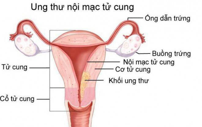 Hình ảnh ung thư nội mạc tử cung.