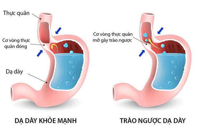 Kinh nghiệm hay: Hành trình &#34;thoát&#34; trào ngược dạ dày và đau dạ dày ngoạn mục - 2