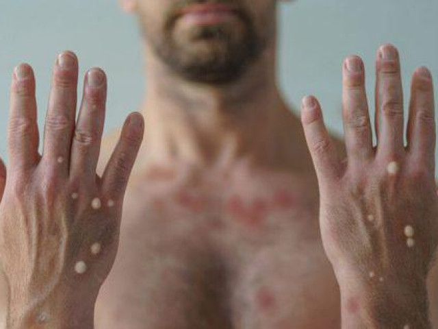 Sức khỏe đời sống - Đậu mùa khỉ: Mỹ báo cáo tử vong nhưng châu Âu đón tin mừng